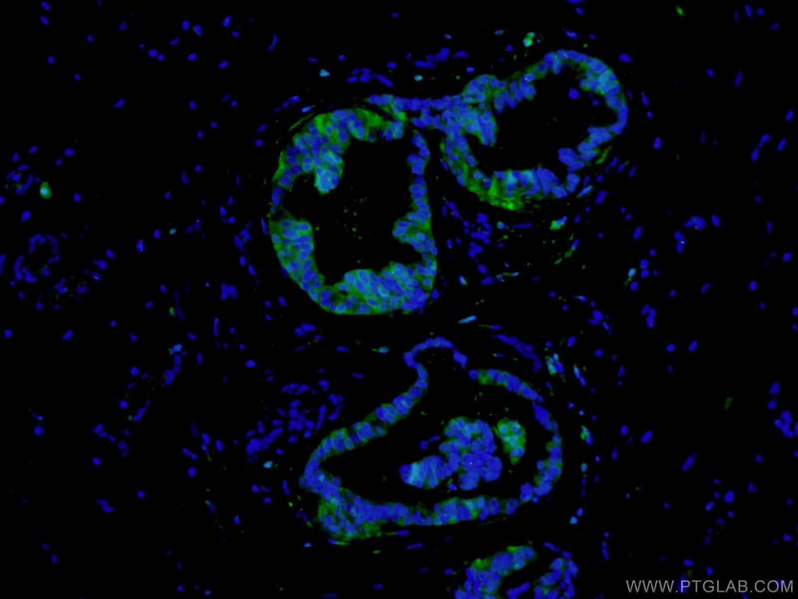 Immunofluorescence (IF) / fluorescent staining of human breast cancer tissue using PADI2 Polyclonal antibody (12110-1-AP)