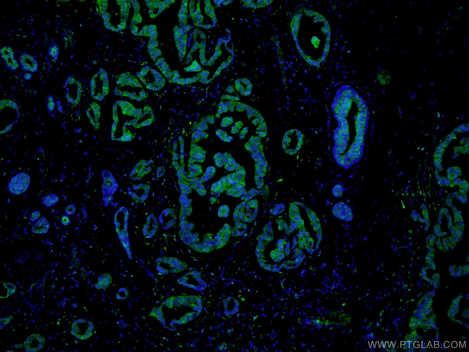 Immunofluorescence (IF) / fluorescent staining of human breast cancer tissue using PADI2 Polyclonal antibody (12110-1-AP)