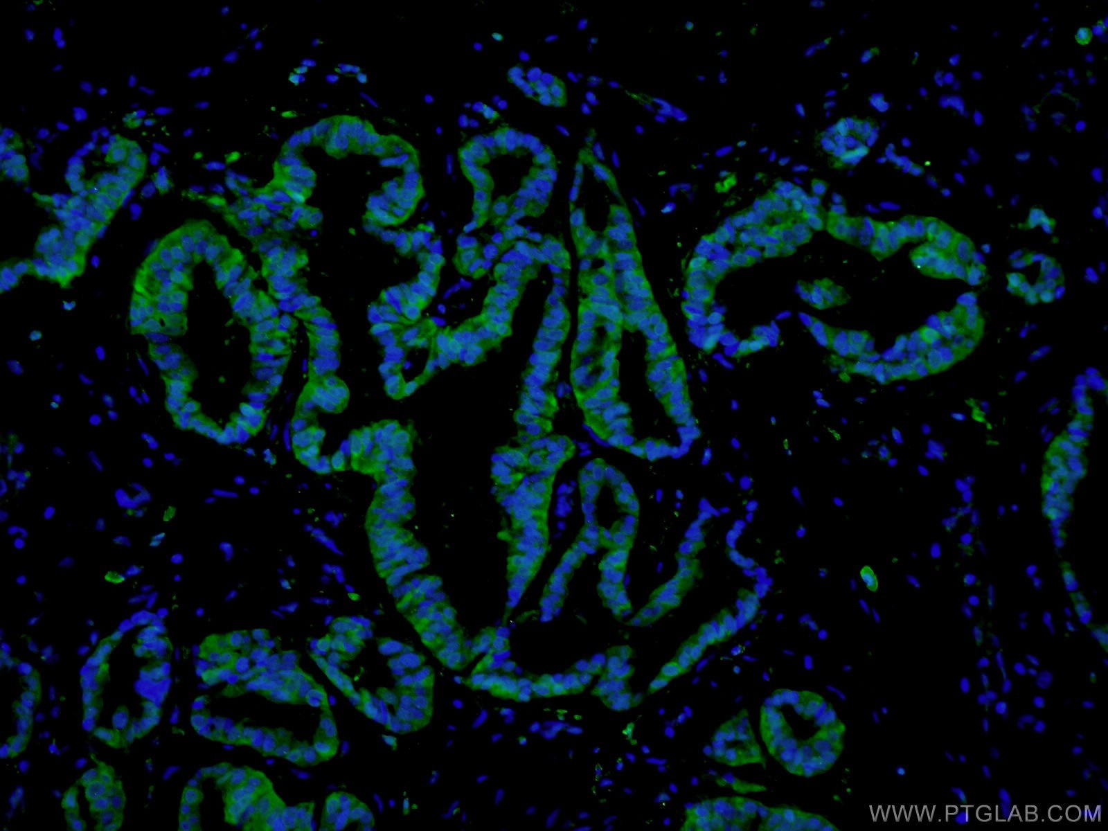 Immunofluorescence (IF) / fluorescent staining of human breast cancer tissue using PADI2 Polyclonal antibody (12110-1-AP)