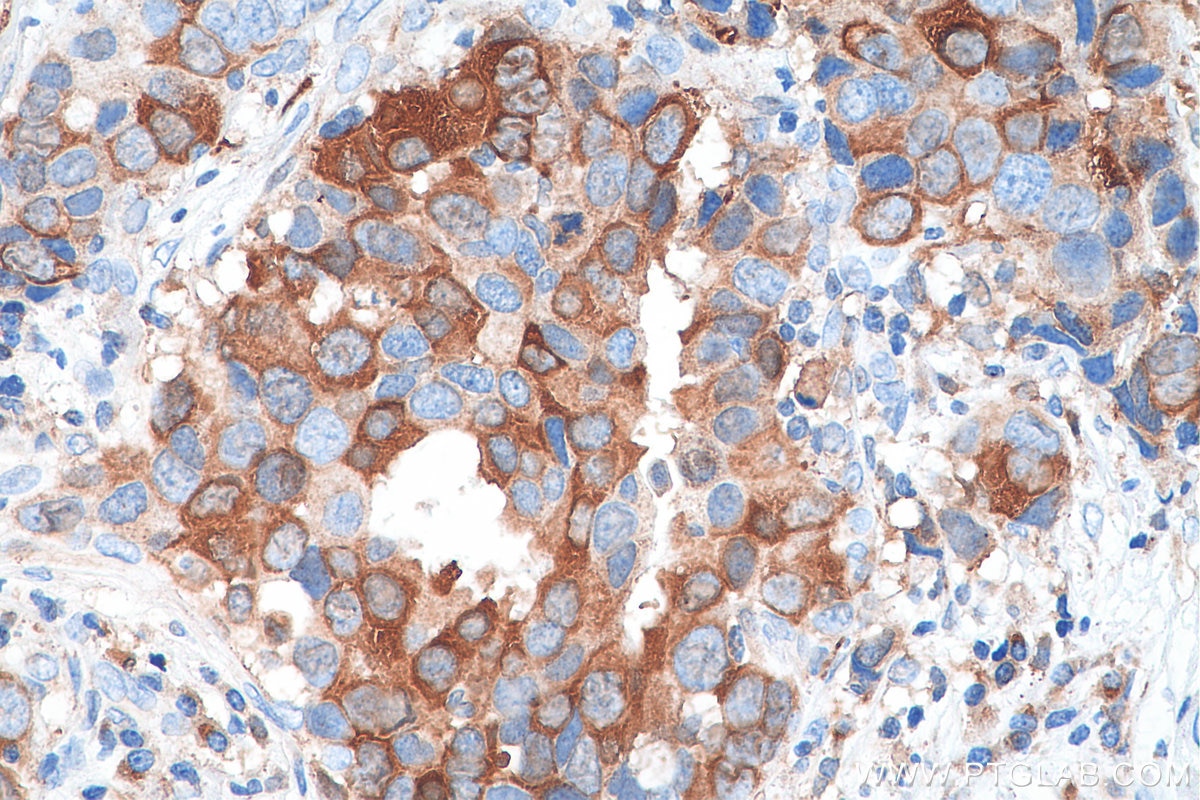 Immunohistochemistry (IHC) staining of human breast cancer tissue using PADI2 Polyclonal antibody (12110-1-AP)