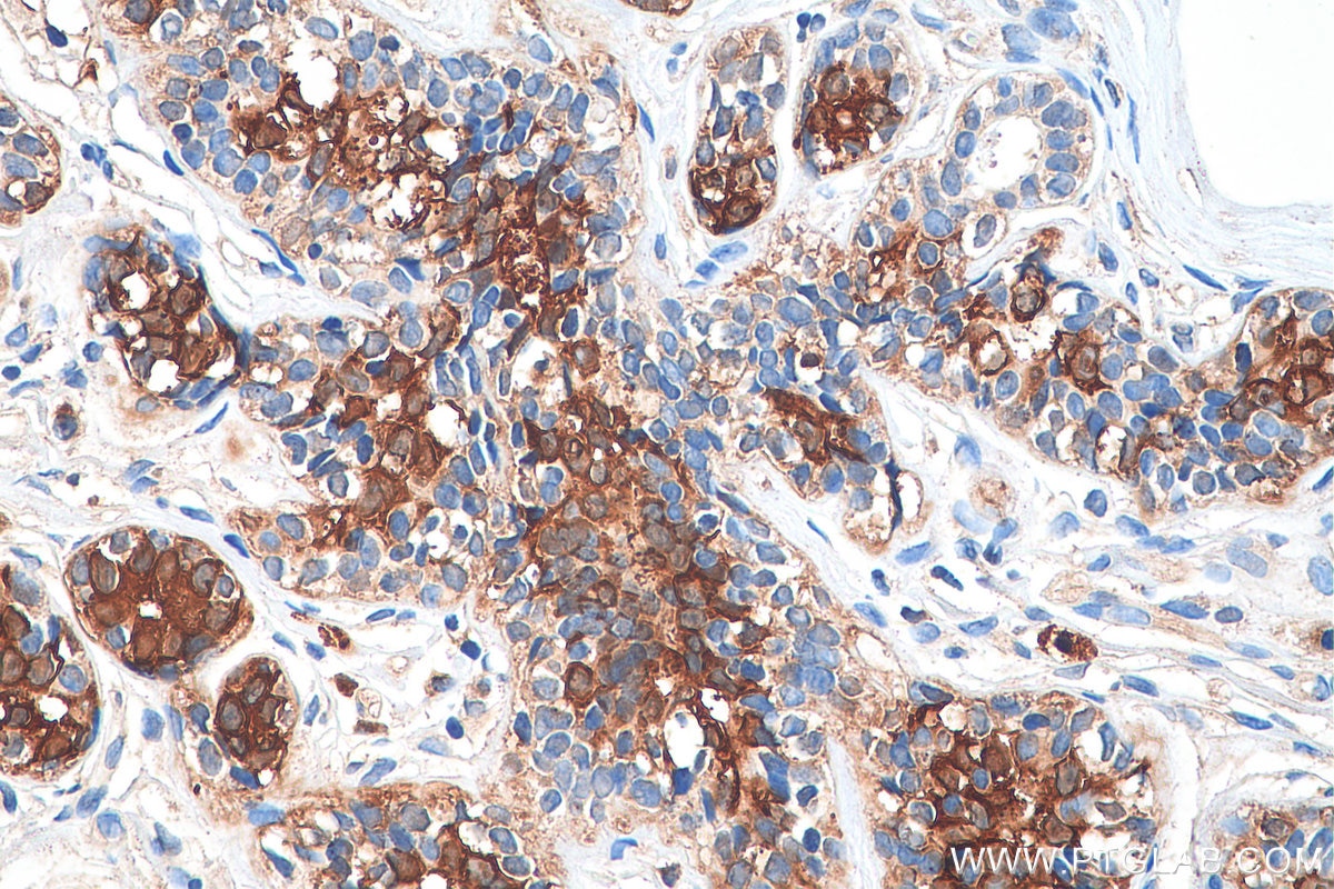 Immunohistochemistry (IHC) staining of human breast cancer tissue using PADI2 Polyclonal antibody (12110-1-AP)
