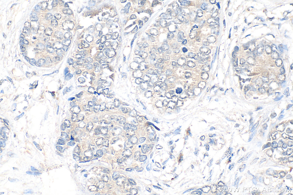 Immunohistochemistry (IHC) staining of human prostate cancer tissue using PADI2 Polyclonal antibody (12110-1-AP)
