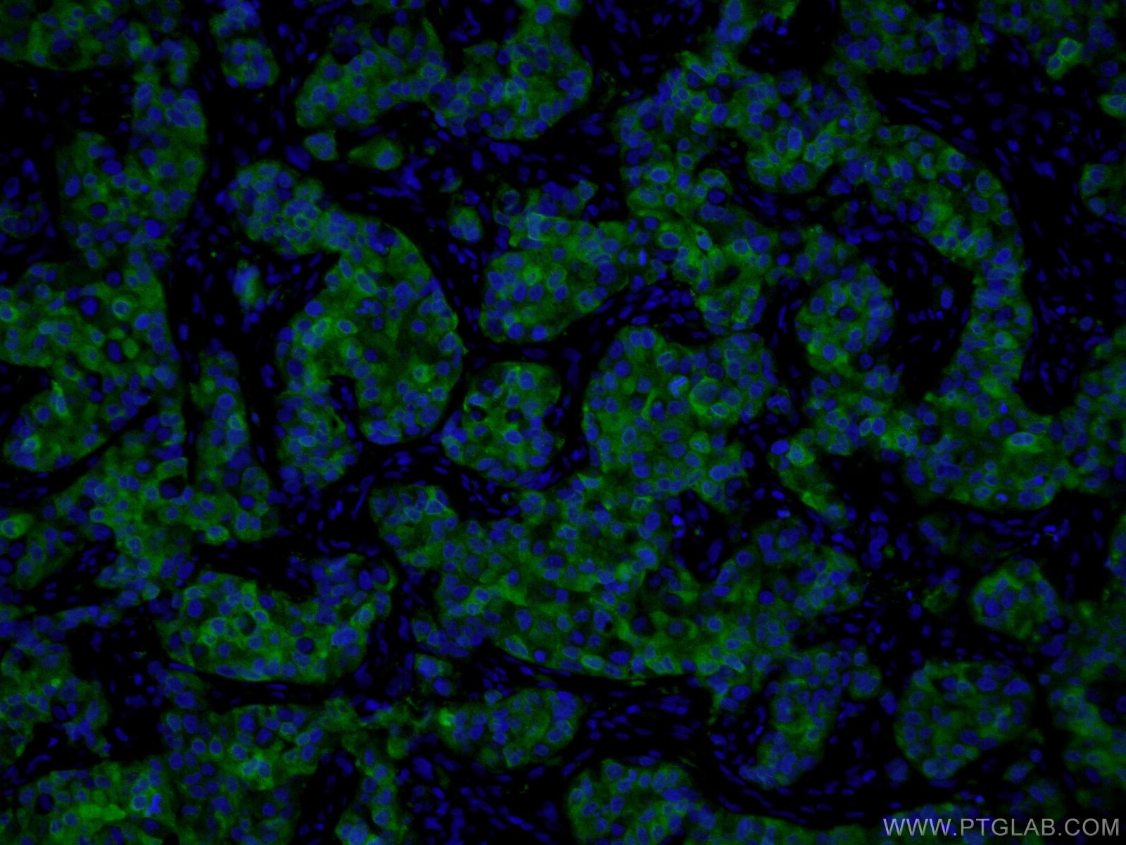 Immunofluorescence (IF) / fluorescent staining of human breast cancer tissue using PADI2 Monoclonal antibody (66386-1-Ig)