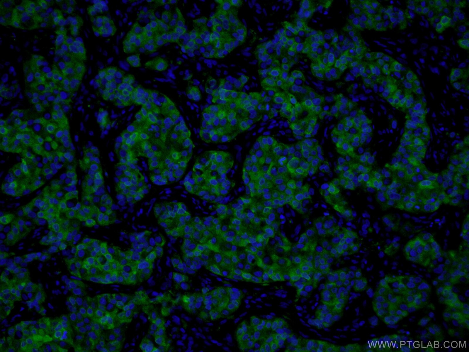 Immunofluorescence (IF) / fluorescent staining of human breast cancer tissue using PADI2 Monoclonal antibody (66386-1-Ig)
