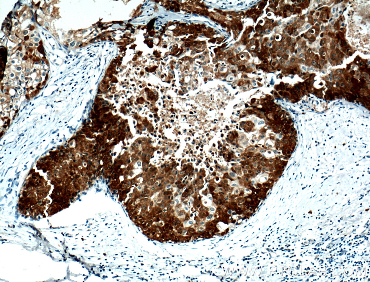 Immunohistochemistry (IHC) staining of human breast cancer tissue using PADI2 Monoclonal antibody (66386-1-Ig)