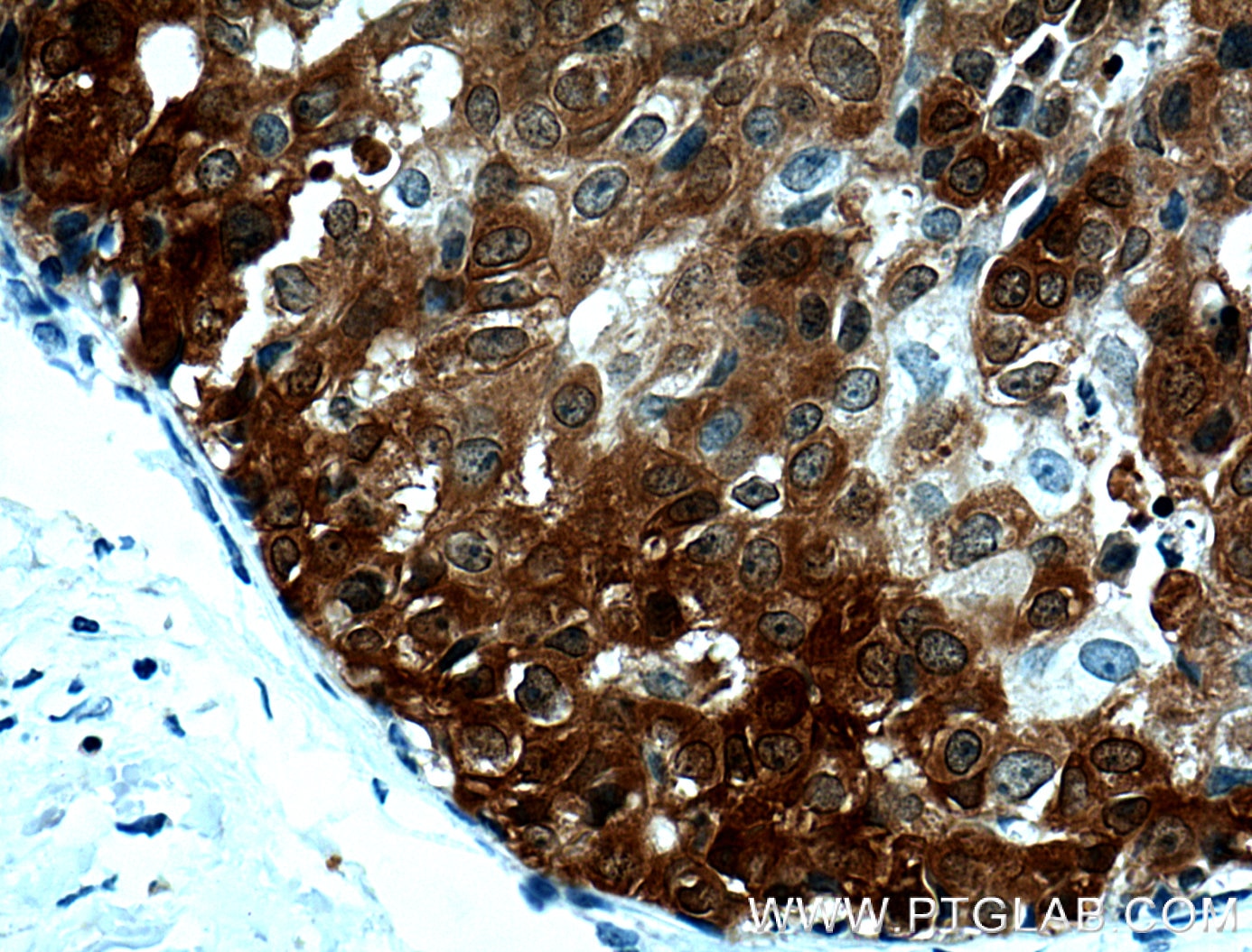 Immunohistochemistry (IHC) staining of human breast cancer tissue using PADI2 Monoclonal antibody (66386-1-Ig)