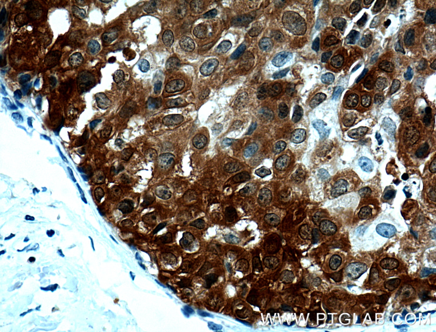 IHC staining of human breast cancer using 66386-1-Ig