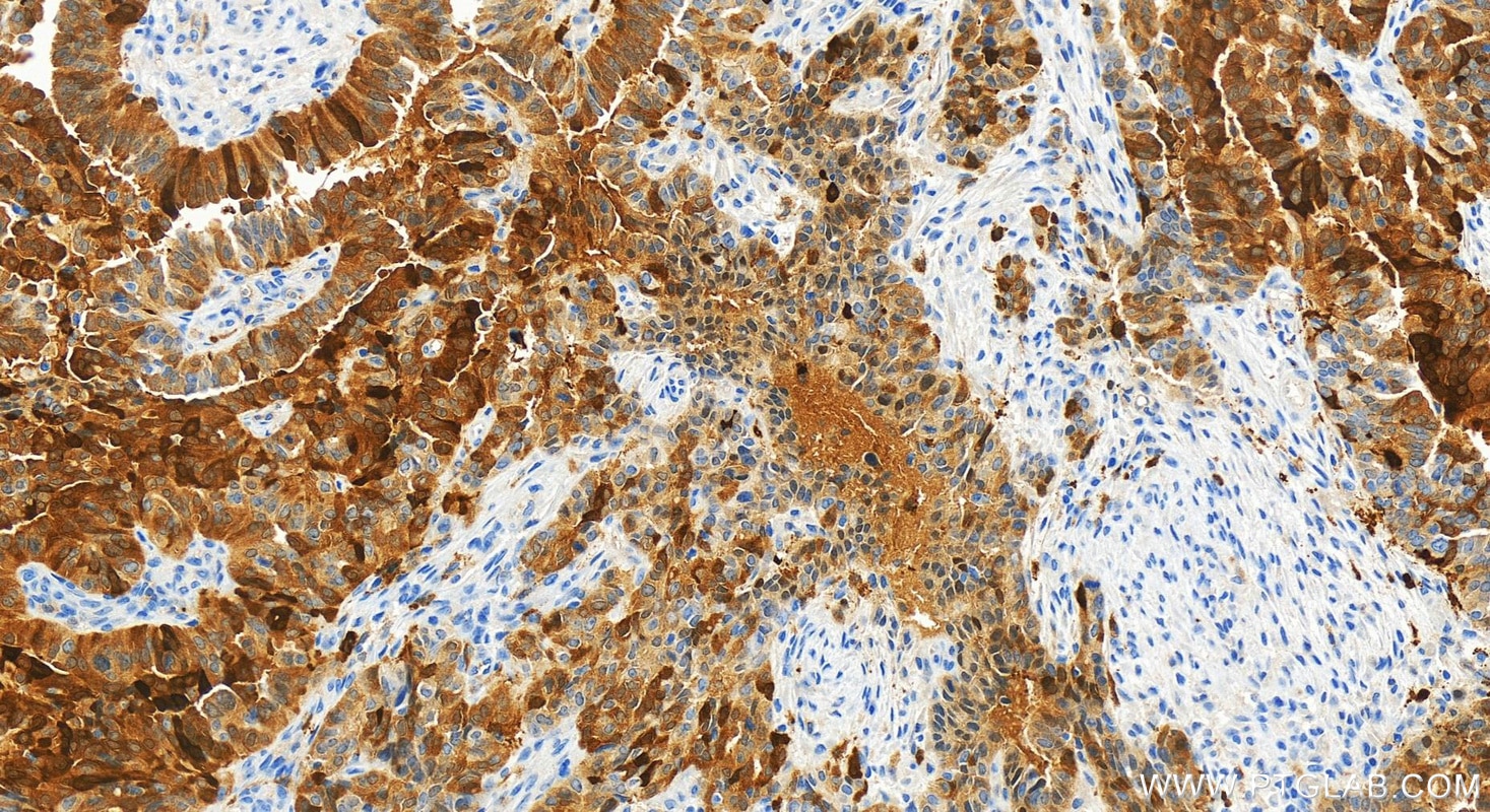 Immunohistochemical analysis of paraffin-embedded human ovarian cancer slide using 83868-1-RR (PADI2 antibody) at dilution of 1:1000 (under 20x lens). Heat mediated antigen retrieval with Tris-EDTA buffer (pH 9.0). Immunohistochemistry (IHC) staining of human ovarian cancer using PADI2 Recombinant monoclonal antibody (83868-1-RR)