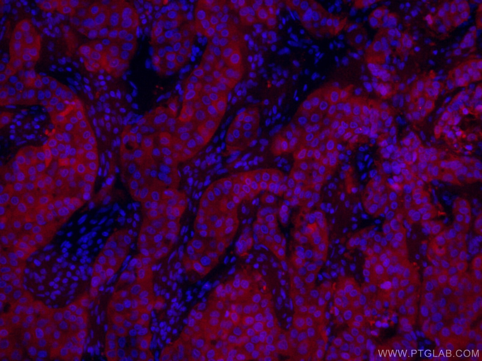 Immunofluorescence (IF) / fluorescent staining of human breast cancer tissue using CoraLite®594-conjugated PADI2 Monoclonal antibody (CL594-66386)
