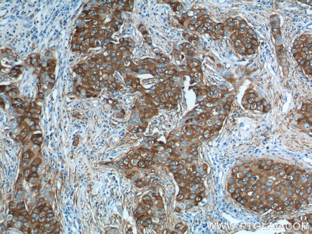Immunohistochemistry (IHC) staining of human breast cancer tissue using PADI4 Polyclonal antibody (17373-1-AP)