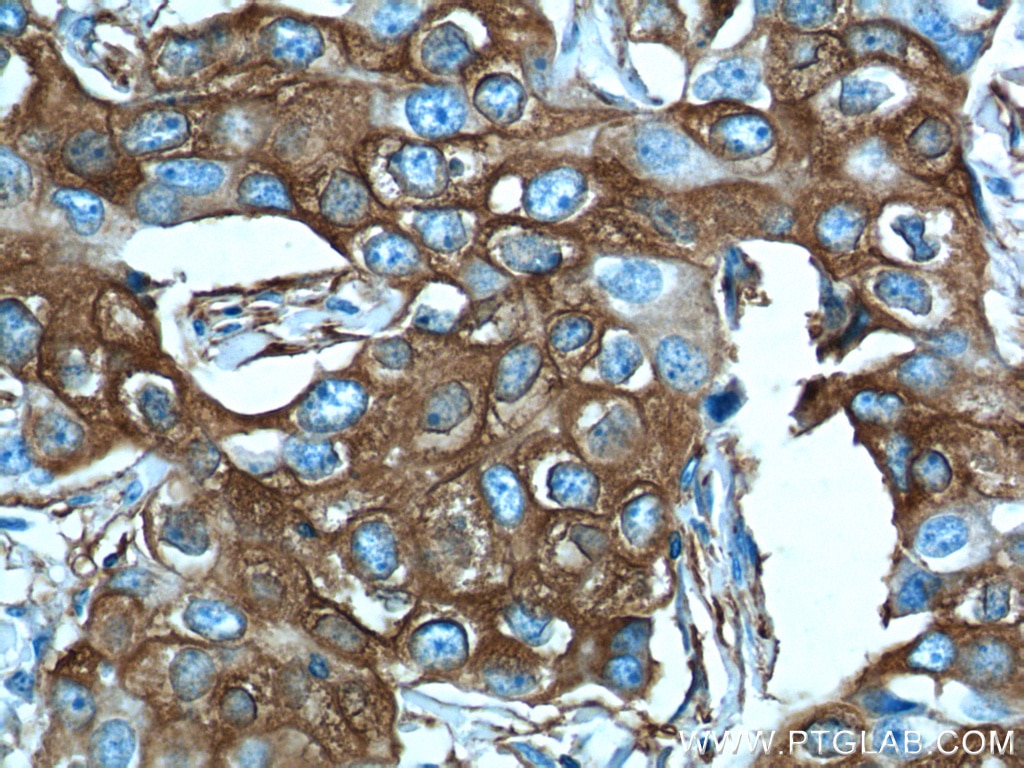 Immunohistochemistry (IHC) staining of human breast cancer tissue using PADI4 Polyclonal antibody (17373-1-AP)