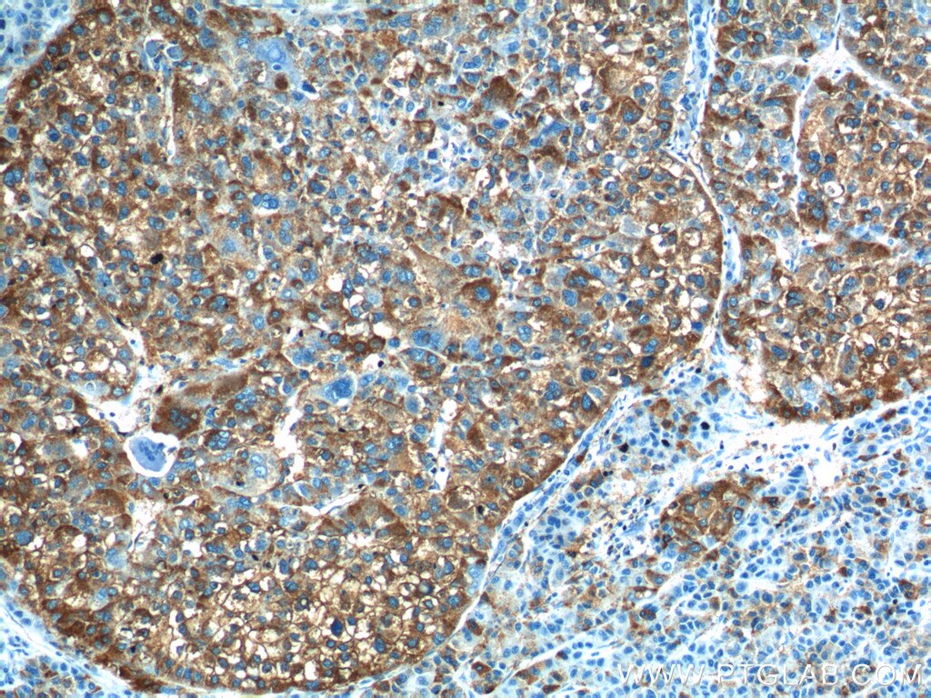 Immunohistochemistry (IHC) staining of human liver cancer tissue using PADI4 Polyclonal antibody (17373-1-AP)