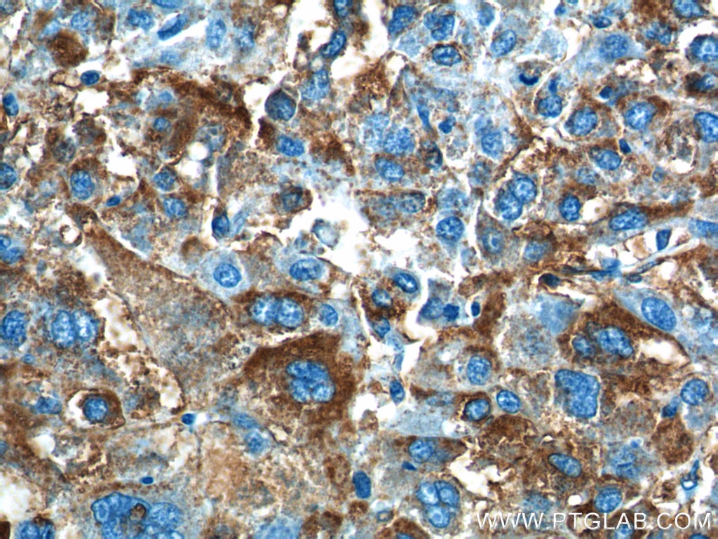 Immunohistochemistry (IHC) staining of human liver cancer tissue using PADI4 Polyclonal antibody (17373-1-AP)
