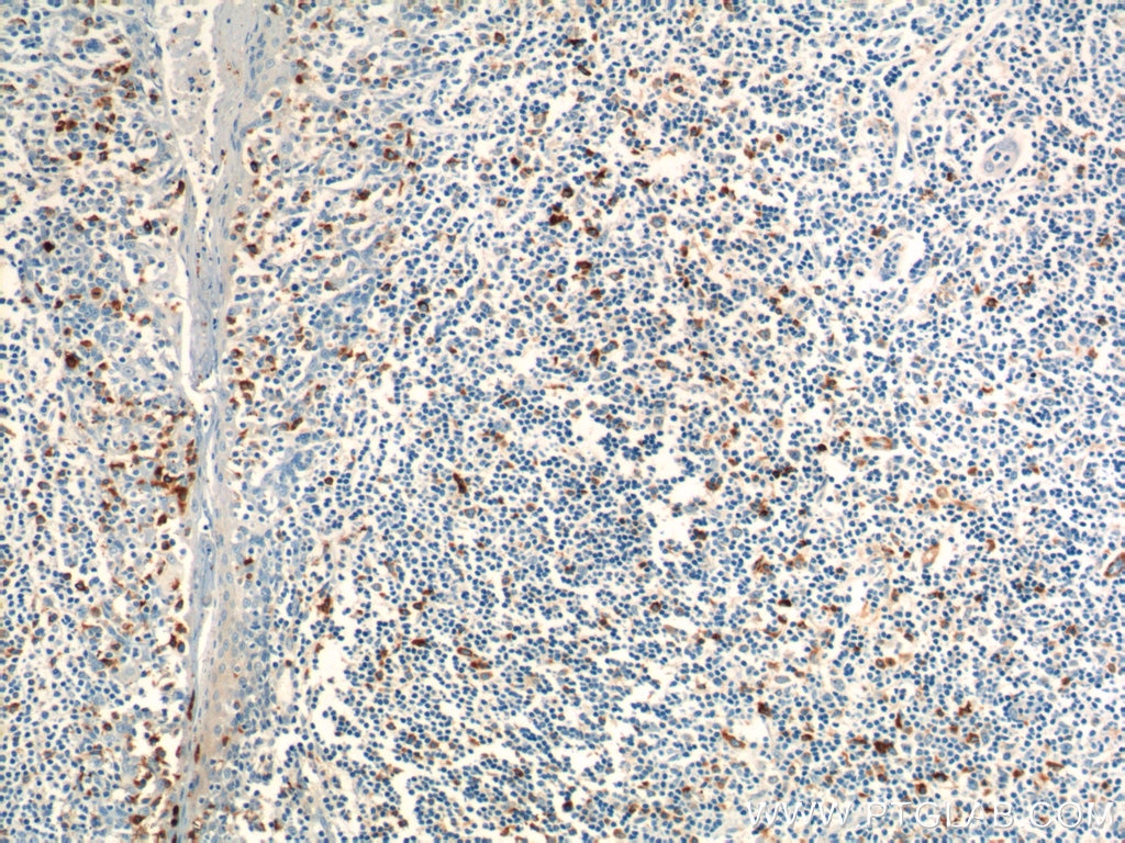 Immunohistochemistry (IHC) staining of human tonsillitis tissue using PADI4 Polyclonal antibody (17373-1-AP)