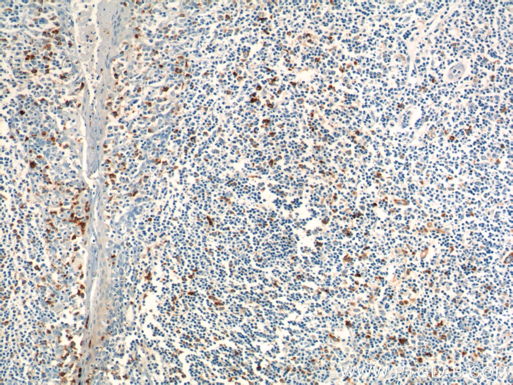 IHC staining of human tonsillitis using 17373-1-AP