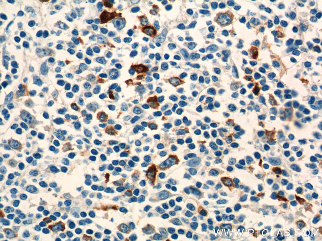 Immunohistochemistry (IHC) staining of human tonsillitis tissue using PADI4 Polyclonal antibody (17373-1-AP)