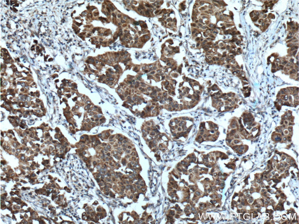 Immunohistochemistry (IHC) staining of human breast cancer tissue using PADI4 Polyclonal antibody (17373-1-AP)