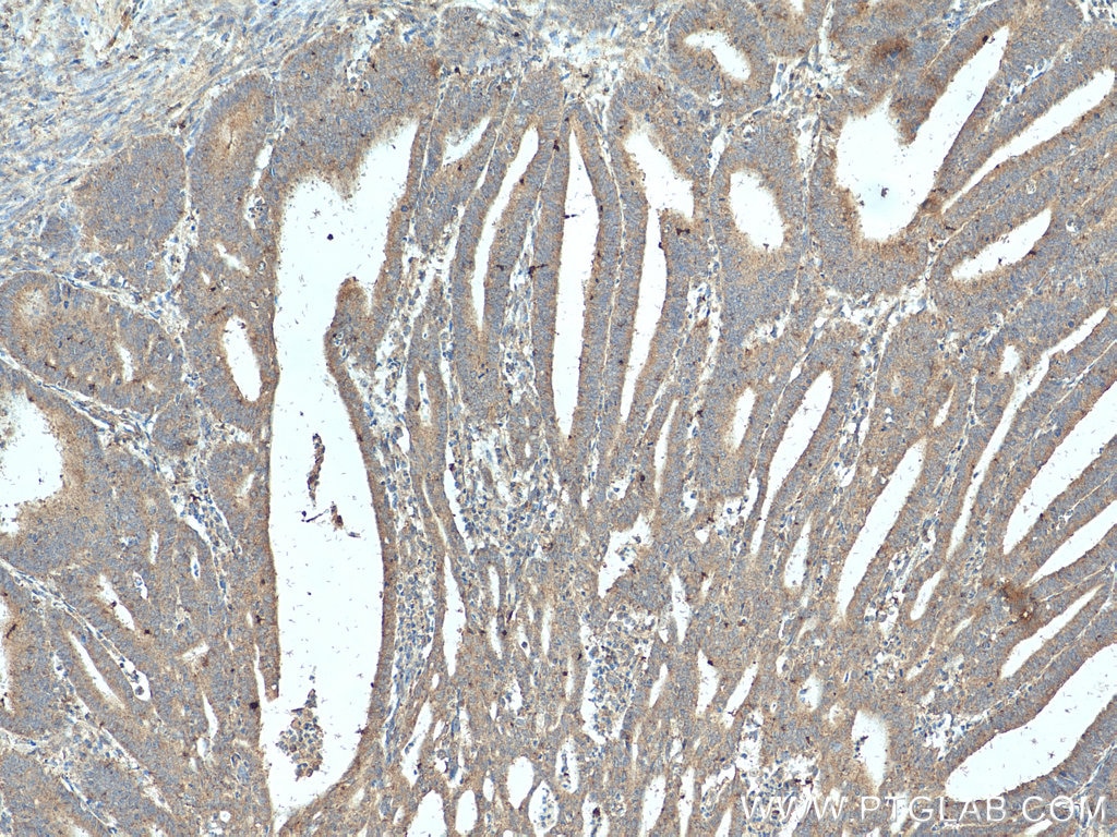 Immunohistochemistry (IHC) staining of human endometrial cancer tissue using PAEP/Glycodelin Polyclonal antibody (18187-1-AP)