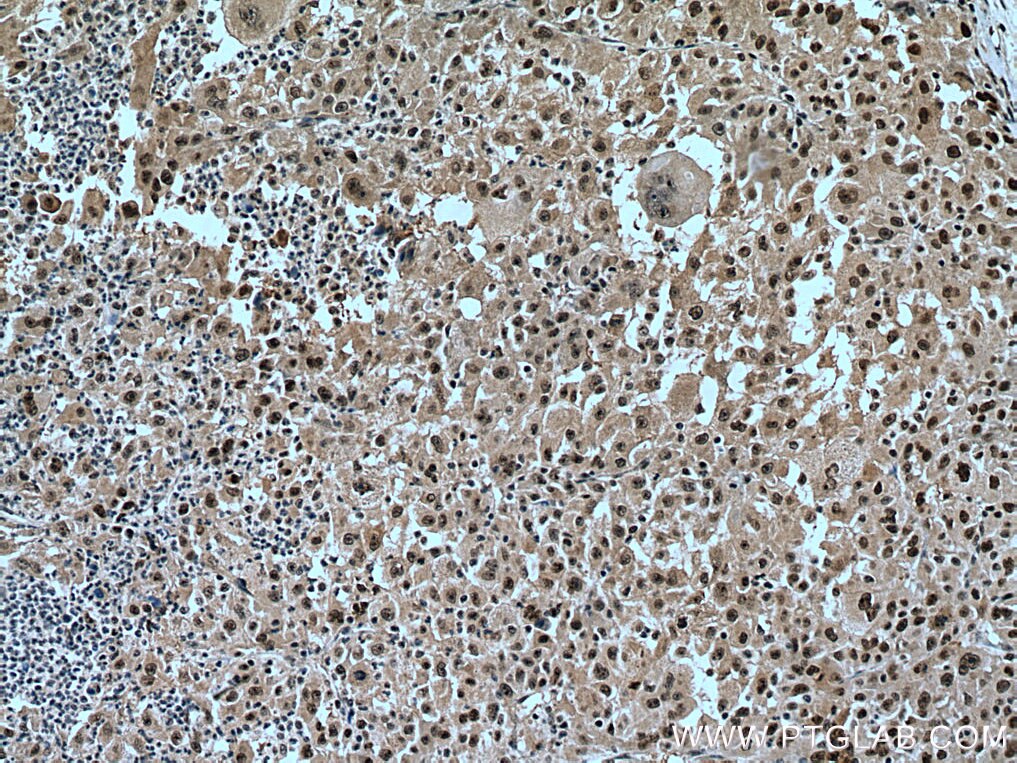 Immunohistochemistry (IHC) staining of human liver cancer tissue using PAF1 Polyclonal antibody (15441-1-AP)