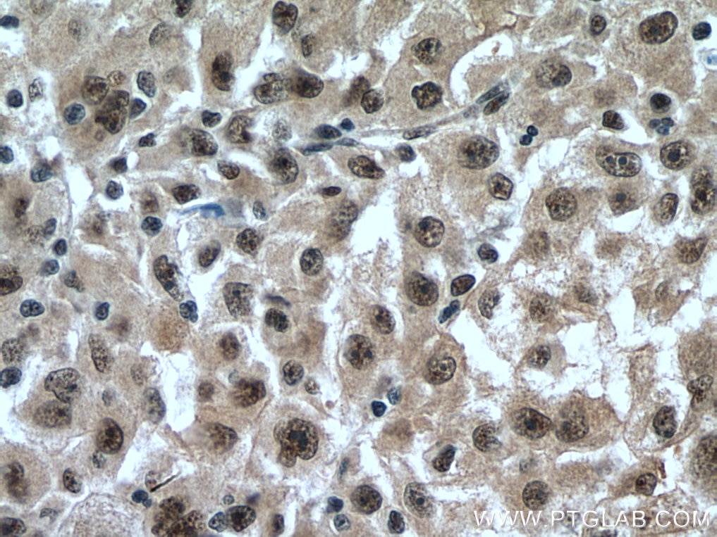 Immunohistochemistry (IHC) staining of human liver cancer tissue using PAF1 Polyclonal antibody (15441-1-AP)