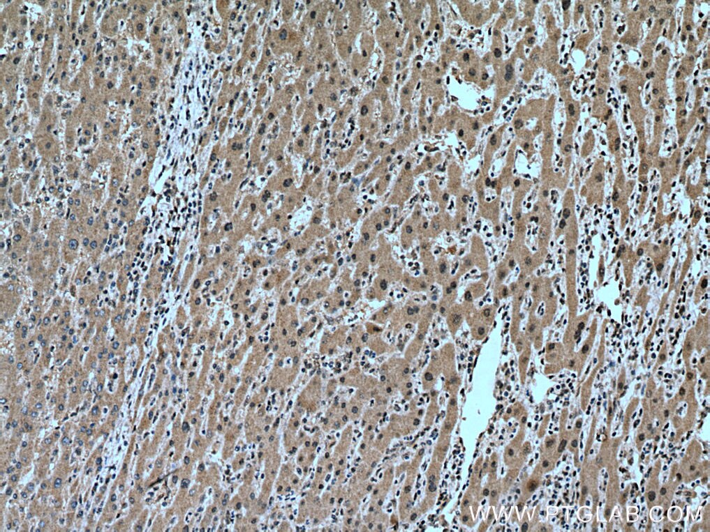 Immunohistochemistry (IHC) staining of human liver cancer tissue using PAF1 Polyclonal antibody (15441-1-AP)