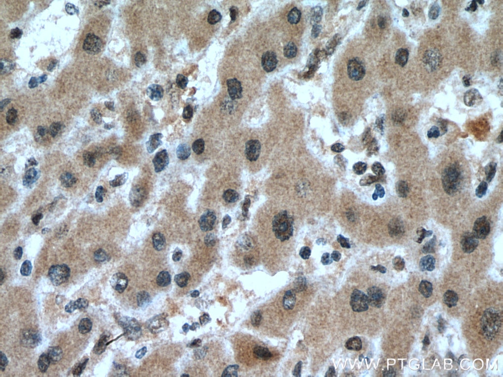 Immunohistochemistry (IHC) staining of human liver cancer tissue using PAF1 Polyclonal antibody (15441-1-AP)