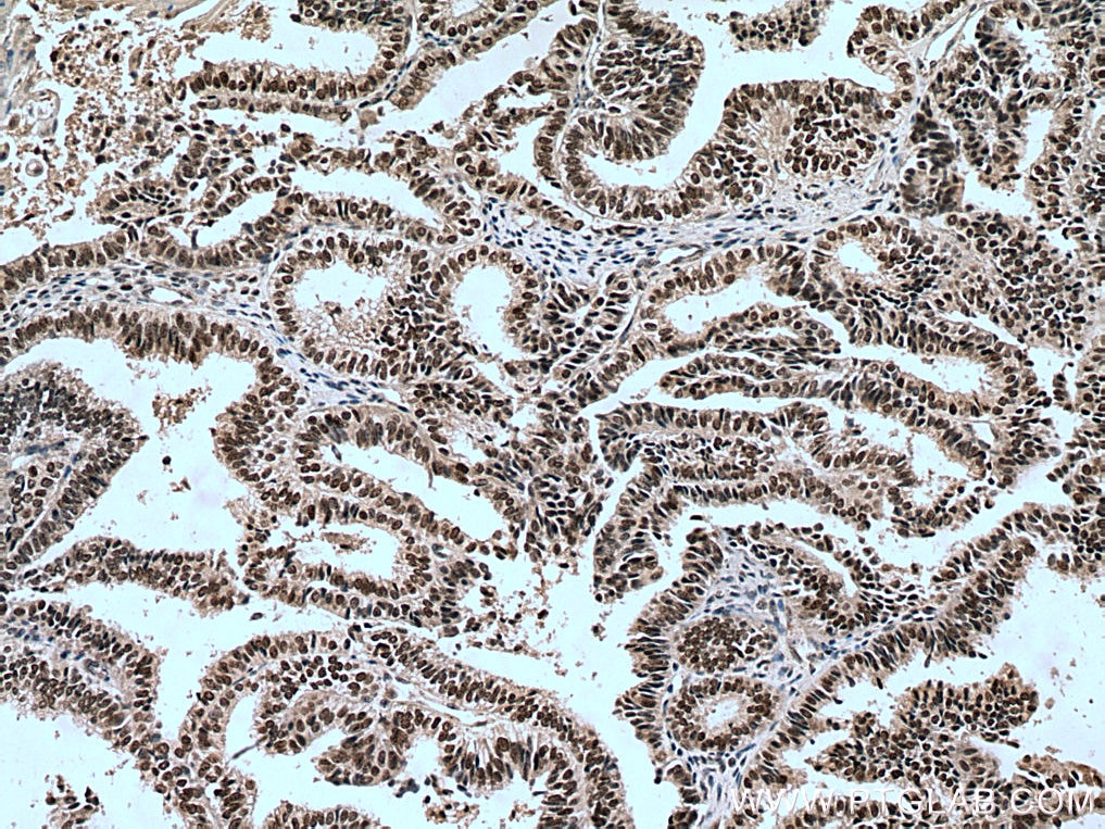 IHC staining of human ovary tumor using 15441-1-AP