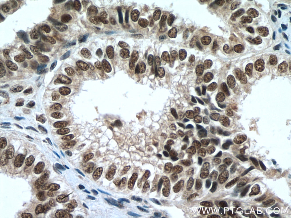 Immunohistochemistry (IHC) staining of human ovary tumor tissue using PAF1 Polyclonal antibody (15441-1-AP)