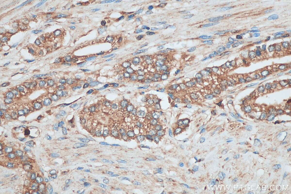 Immunohistochemistry (IHC) staining of human prostate cancer tissue using PAFAH Polyclonal antibody (29304-1-AP)