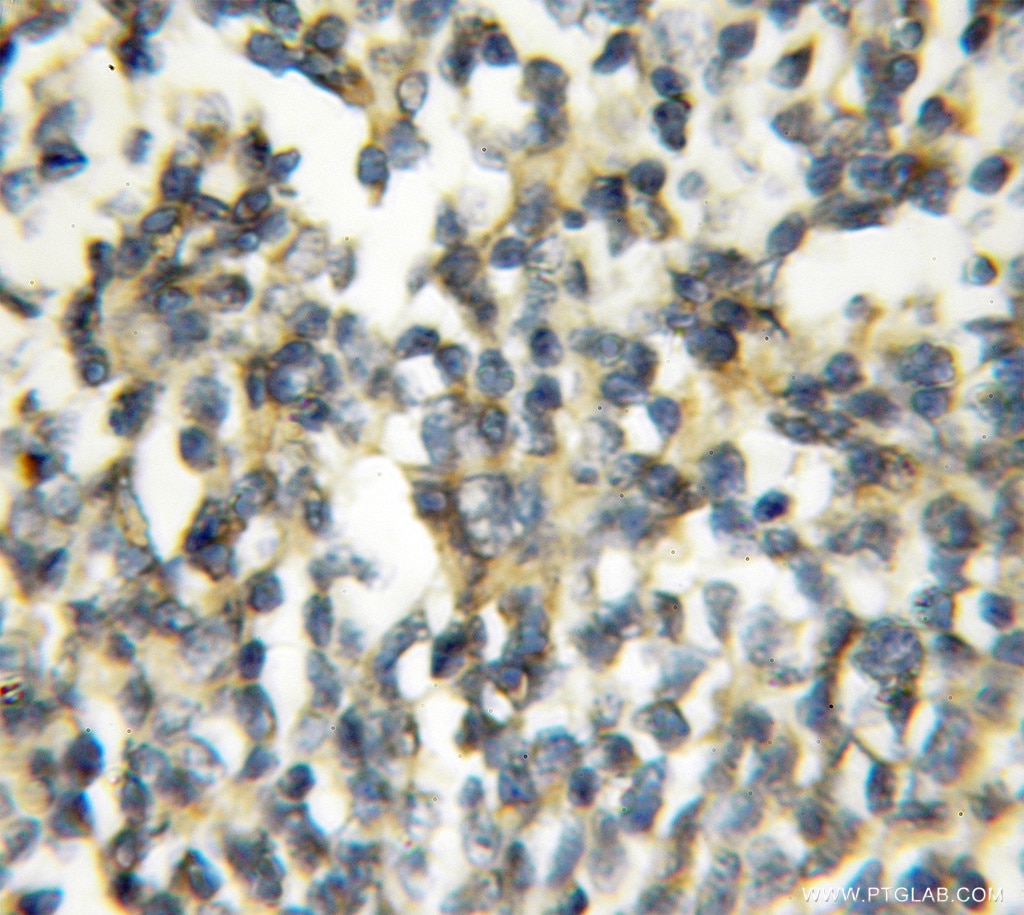 IHC staining of human lymphoma using 10085-1-AP