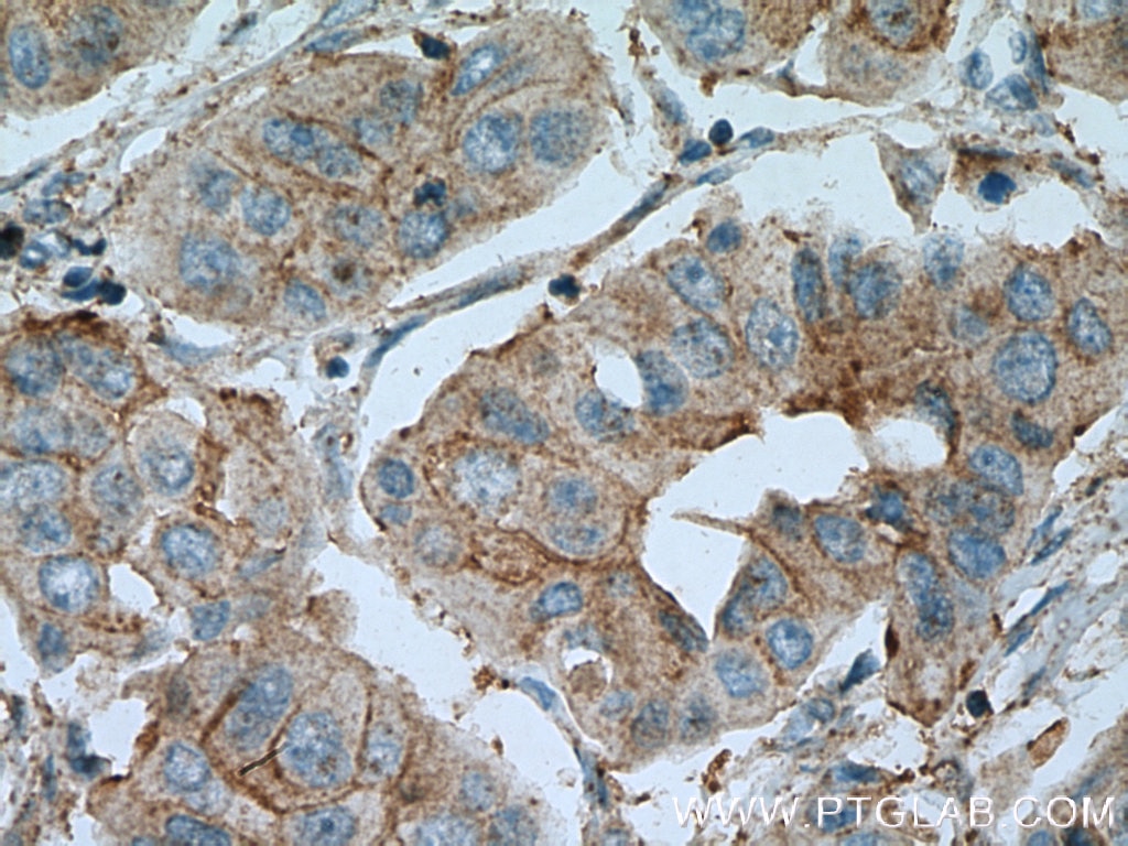 Immunohistochemistry (IHC) staining of human breast cancer tissue using PAGE3 Polyclonal antibody (24598-1-AP)