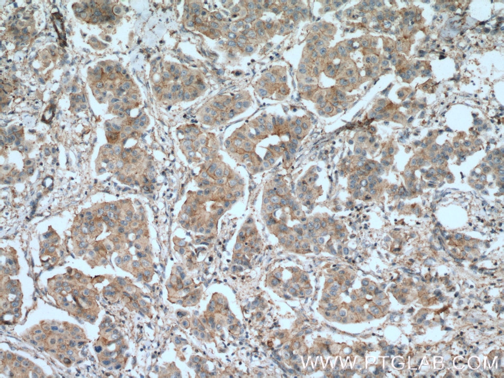 Immunohistochemistry (IHC) staining of human breast cancer tissue using PAGE3 Polyclonal antibody (24598-1-AP)