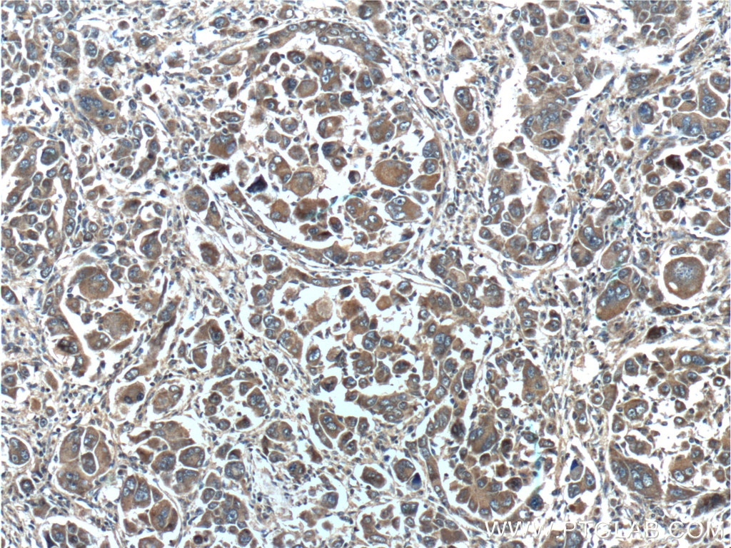 Immunohistochemistry (IHC) staining of human liver cancer tissue using PAH Polyclonal antibody (16347-1-AP)