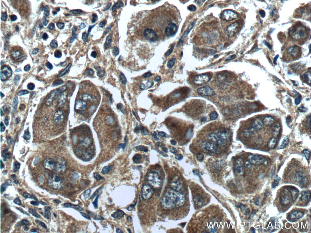 Immunohistochemistry (IHC) staining of human liver cancer tissue using PAH Polyclonal antibody (16347-1-AP)