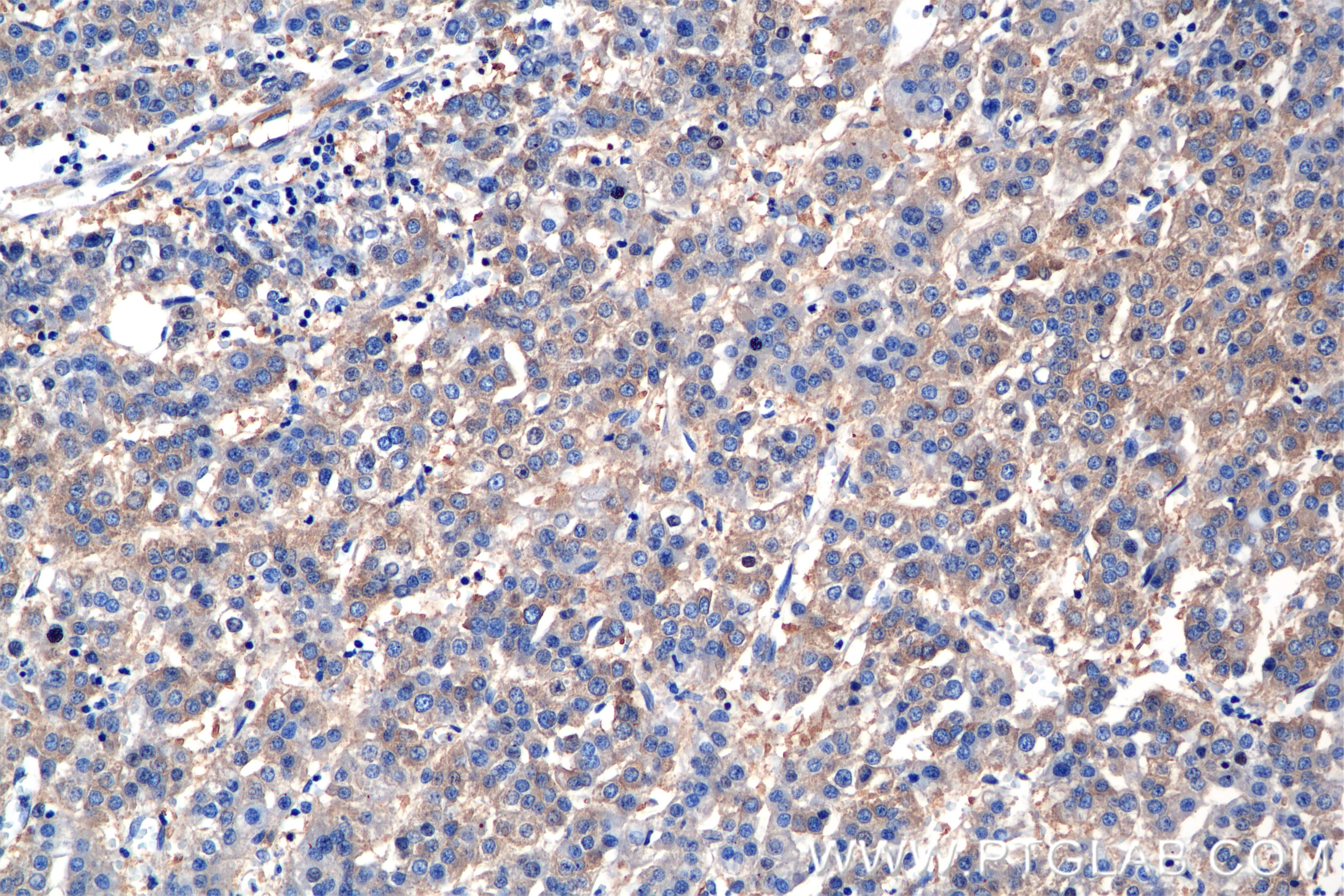Immunohistochemistry (IHC) staining of human hepatocellular cancer using PAICS Recombinant antibody (86255-2-RR)
