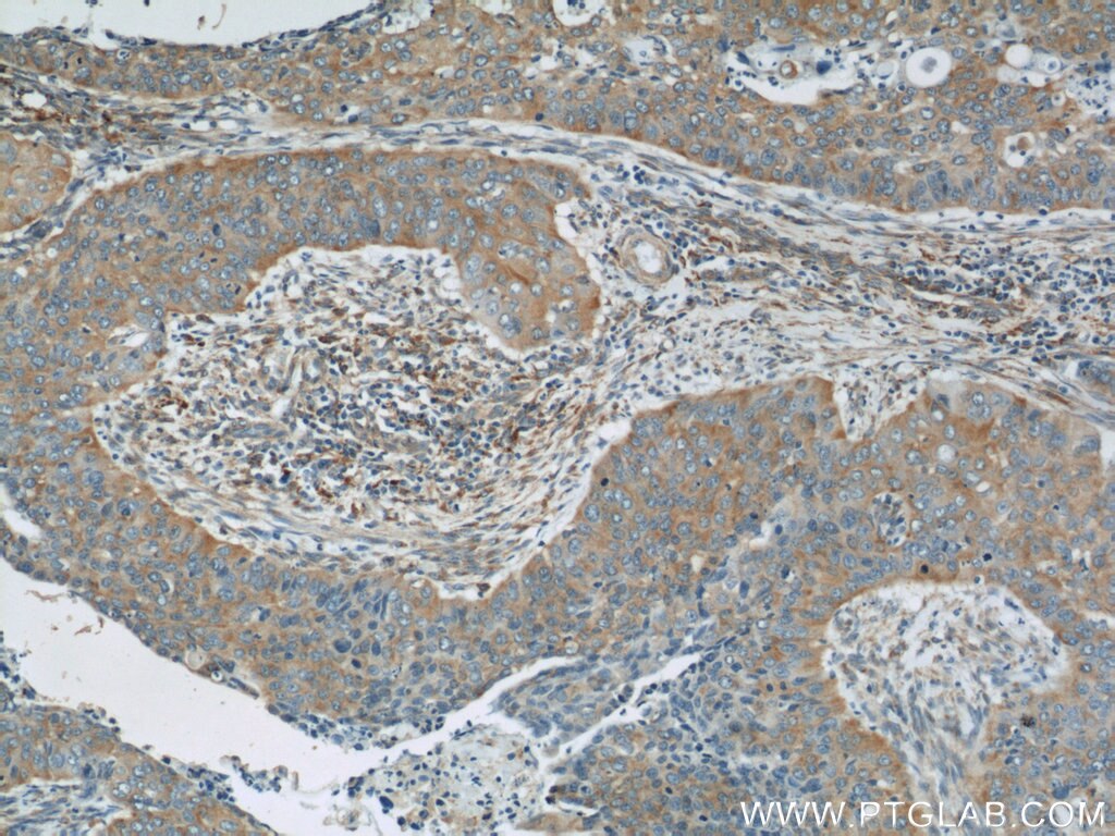 Immunohistochemistry (IHC) staining of human cervical cancer tissue using PAIP1 Monoclonal antibody (60050-1-Ig)