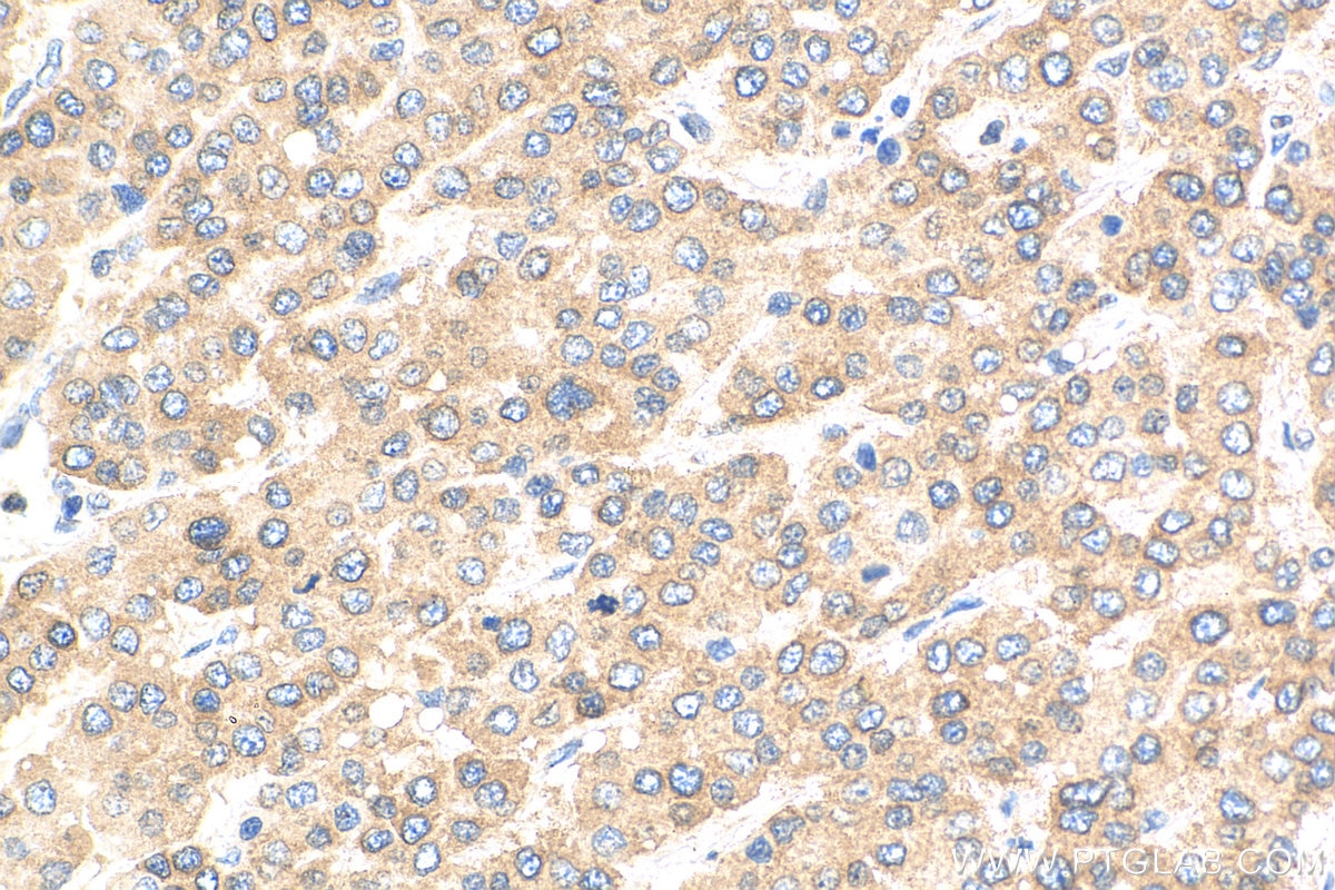 Immunohistochemistry (IHC) staining of human liver cancer tissue using PAIP1 Monoclonal antibody (68042-1-Ig)