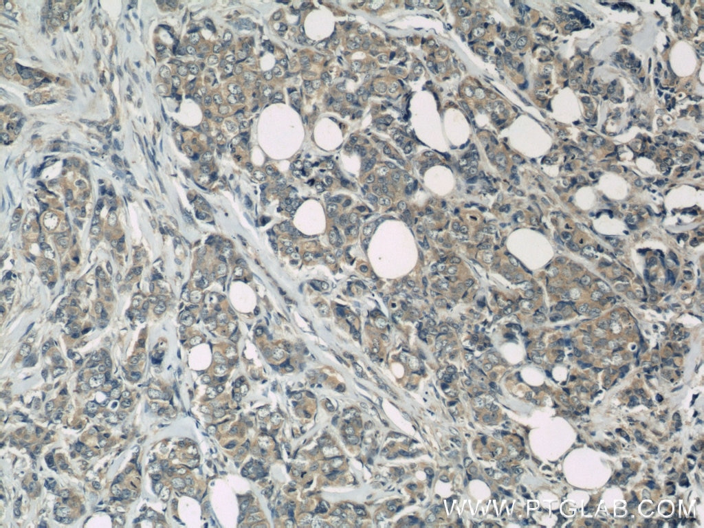 Immunohistochemistry (IHC) staining of human breast cancer tissue using PAK1 Polyclonal antibody (21401-1-AP)