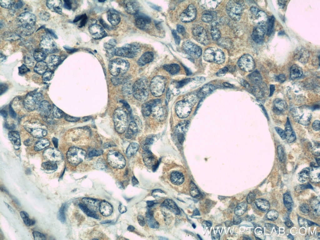 IHC staining of human breast cancer using 21401-1-AP