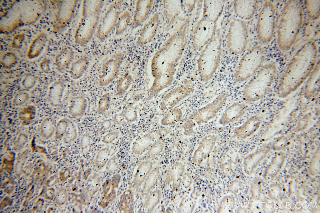 Immunohistochemistry (IHC) staining of human stomach cancer tissue using PAK1 Polyclonal antibody (51137-1-AP)