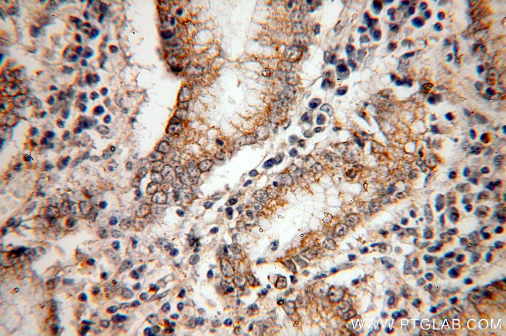 Immunohistochemistry (IHC) staining of human stomach cancer tissue using PAK1 Polyclonal antibody (51137-1-AP)