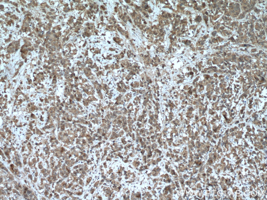 Immunohistochemistry (IHC) staining of human prostate cancer tissue using PAK6 Polyclonal antibody (13539-1-AP)