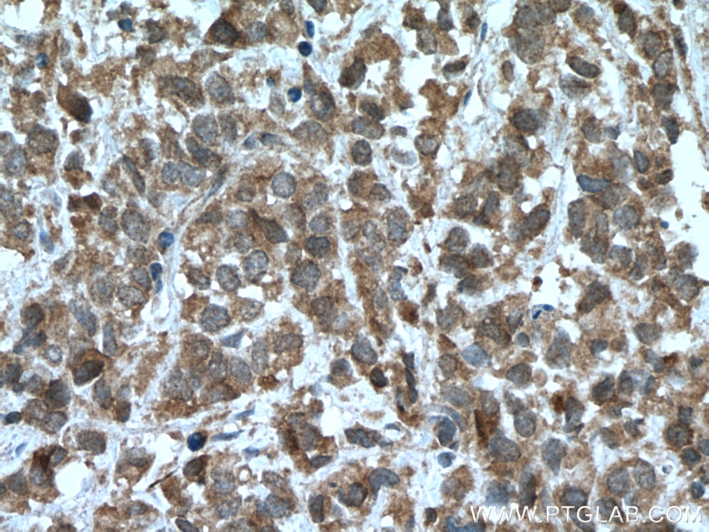 Immunohistochemistry (IHC) staining of human prostate cancer tissue using PAK6 Polyclonal antibody (13539-1-AP)