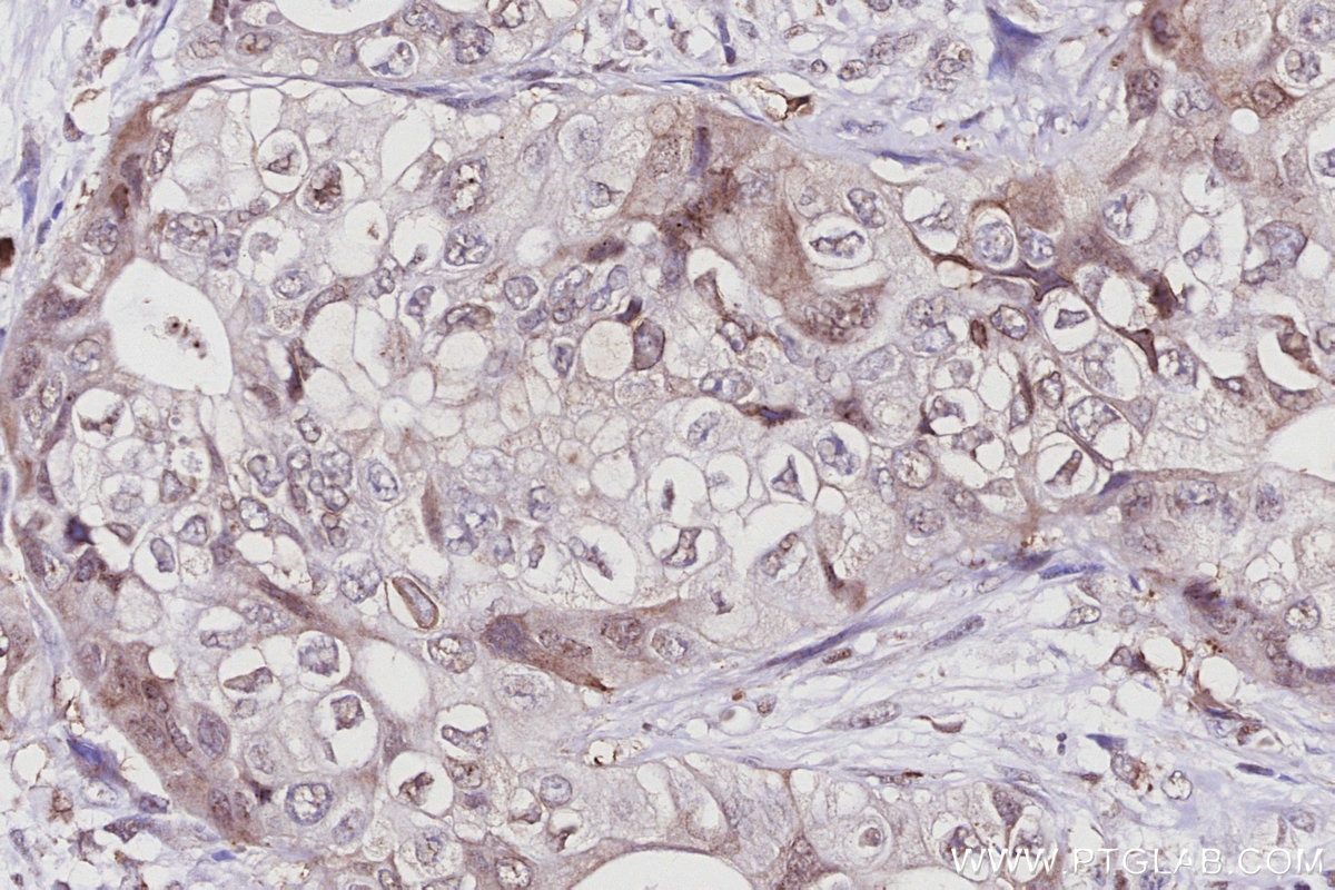 IHC staining of human pancreas cancer using 67562-1-Ig Immunohistochemistry (IHC) staining of human pancreas cancer tissue using PAK6 Monoclonal antibody (67562-1-Ig)