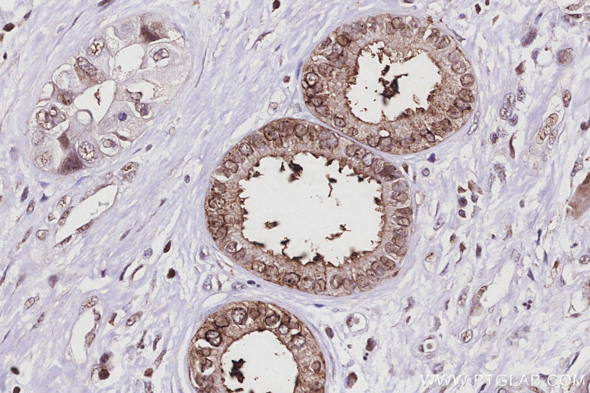 IHC staining of human pancreas cancer using 67562-1-Ig Immunohistochemistry (IHC) staining of human pancreas cancer tissue using PAK6 Monoclonal antibody (67562-1-Ig)