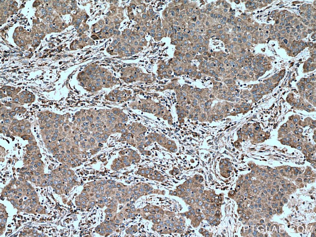 Immunohistochemistry (IHC) staining of human breast cancer tissue using PALB2 Polyclonal antibody (14340-1-AP)