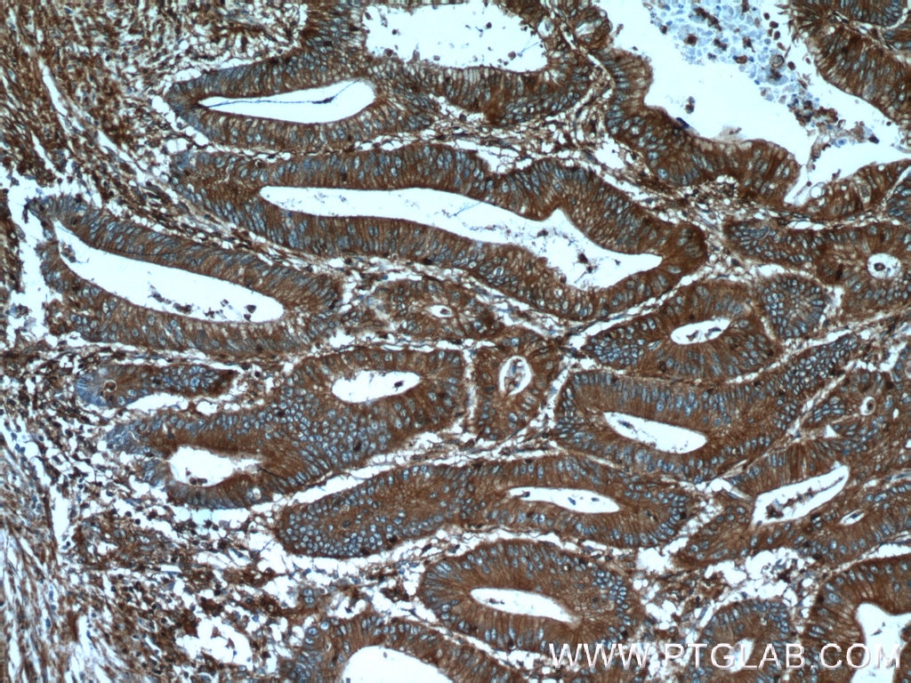 Immunohistochemistry (IHC) staining of human colon cancer tissue using Palladin Polyclonal antibody (10853-1-AP)