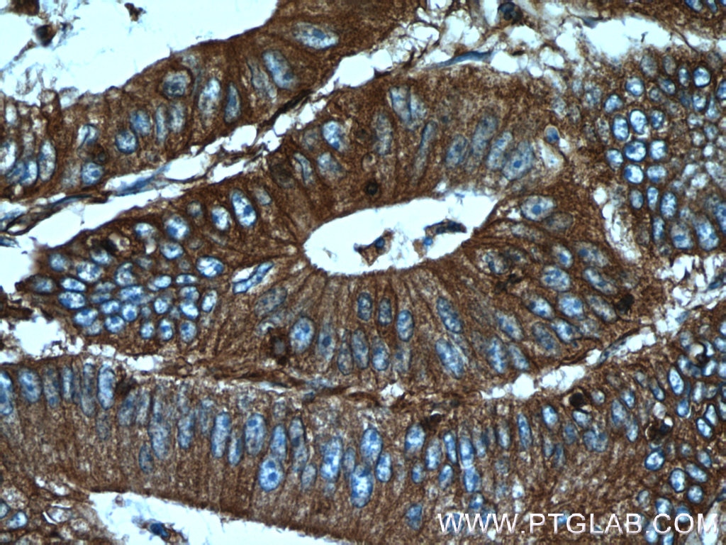 Immunohistochemistry (IHC) staining of human colon cancer tissue using Palladin Polyclonal antibody (10853-1-AP)