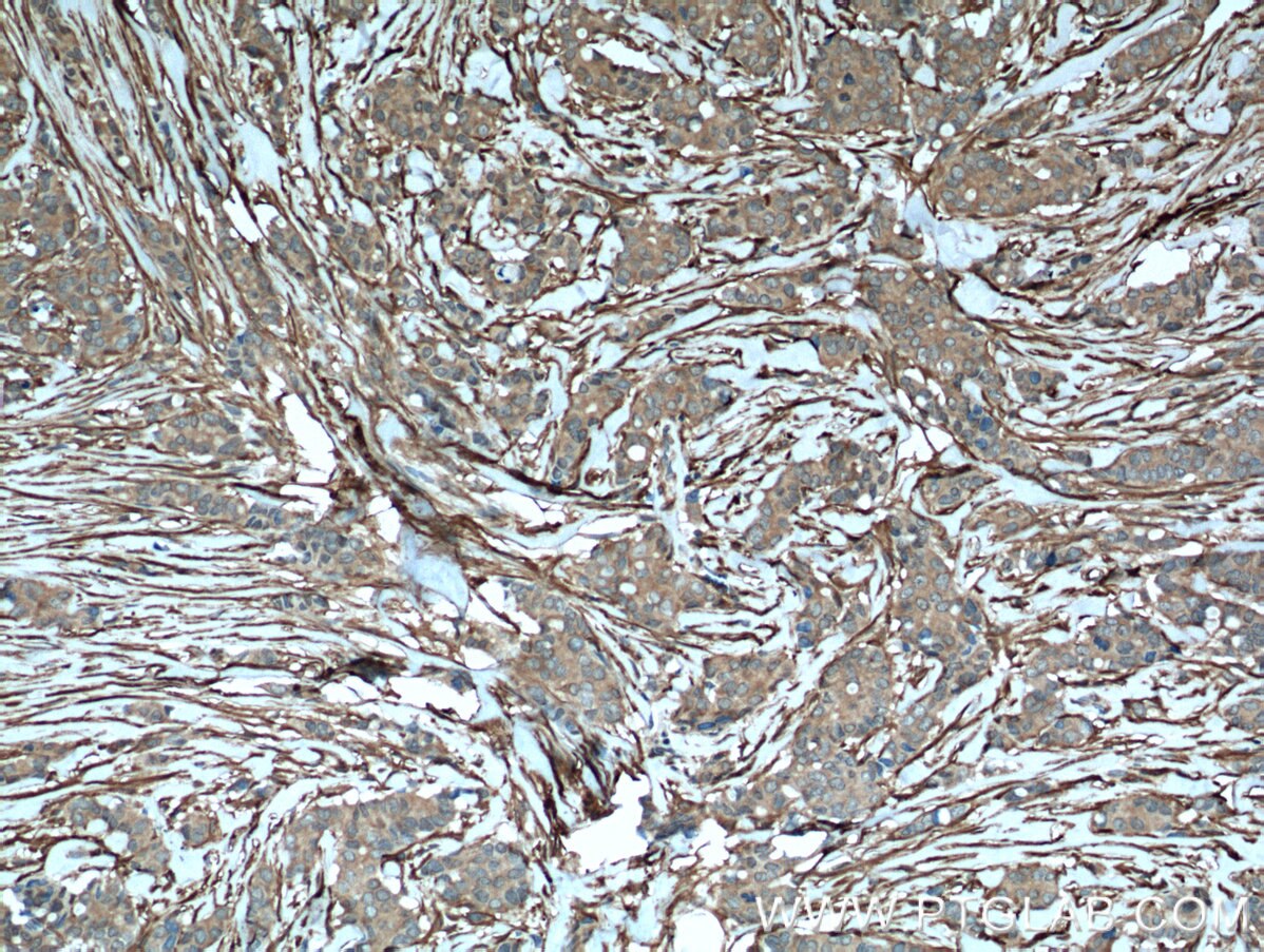 Immunohistochemistry (IHC) staining of human breast cancer tissue using Palladin Polyclonal antibody (10853-1-AP)