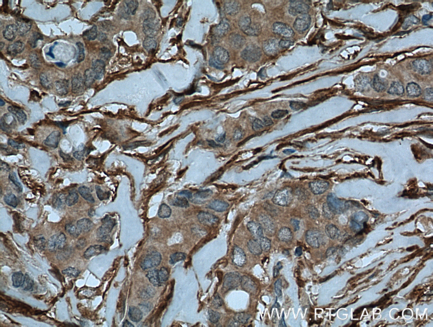 Immunohistochemistry (IHC) staining of human breast cancer tissue using Palladin Polyclonal antibody (10853-1-AP)